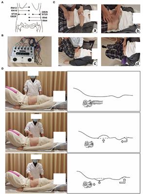 Efficacy of electro-acupuncture in postpartum with diastasis recti abdominis: A randomized controlled clinical trial